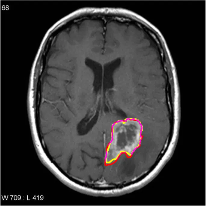 MRI scan with tumor segmentation overlay